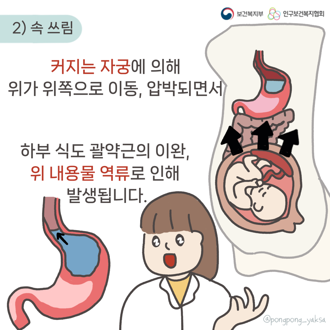 보건복지부 로고,인구보건복지협회 로고,2) 속 쓰림,커지는 자궁에 의해 위가 위쪽으로 이동, 압박되면서 하두 식도 괄약근의 이완, 위 내용물 역류로 인해 발생됩니다.,@pongpong_yaksa