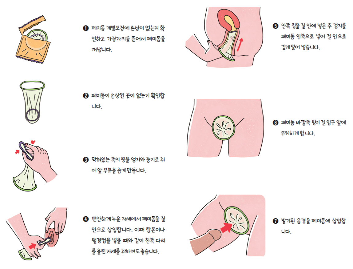 페미돔 사용방법 1. 페미돔 개별포장에 손상이 없는지 확인하고 가장자리를 뜯어서 페미돔을 꺼냅니다. 2. 페미돔이 손상된 곳이 없는지 확인합니다. 3. 막혀있는 쪽의 링을 엄지와 중지로 쥐어 앞 부분을 좁게만듭니다. 4. 편안하게 누운 자세에서 페미돔을 질안으로 삽입합니다. 이때 탐폰이나 월경컵을 넣을 때와 같이 한쪽 다리를 올린 자세를 취하여도 좋습니다. 5. 안쪽 링을 질 안에 넣은 후 검지를 페미돔 안쪽으로 넣어 질 안으로 깊게 밀어 넣습니다. 6. 페미돔 바깥쪽 링이 질 입구 앞에 위치하게 합니다. 7. 발기된 음경을 페미돔에 삽입합니다.