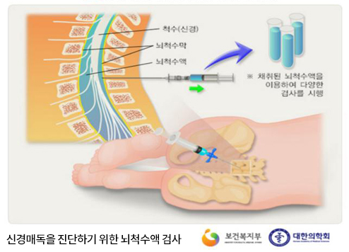 선천성 매독을 진단하기 위한 뇌척수액 검사, 채취된 뇌척수액을 이용하여 다양한 검사를 시행