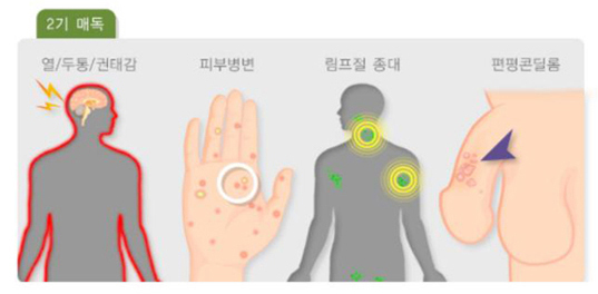 후천성 매독 2기 증상 피부 발진 열, 두통, 권태감, 피부병변, 림프질 종대, 편평콘딜룸