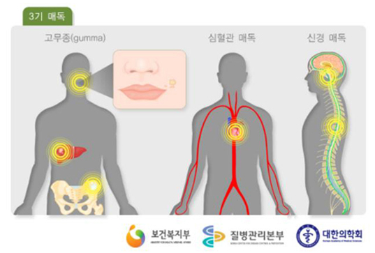 후천성 매독 3기 복기는 수개월에서 수년 동안 지속되고 매독 종류는 고무종(gumma), 심혈관매독, 신경매독 등이 있다.